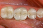 Fillings_A