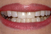 Veneers_A