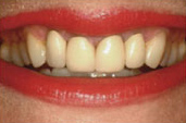 Whitening_B